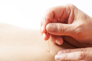 Acupuncture Orpington