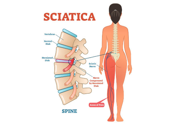 SCIATICA AND LEG WEAKNESS: A WORRYING COMBO