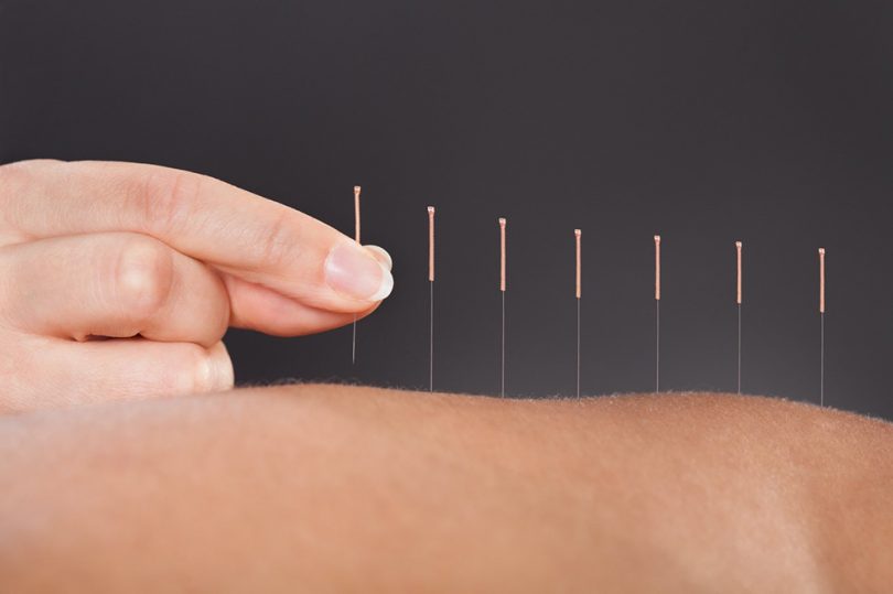 benefits-of-acupuncture